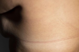 Auch bei farbigen Aktfotos stören die Abdrücke vom BH